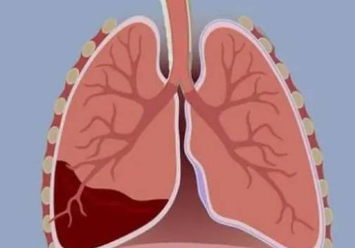 宫外孕在报销范围之内吗,宫保守治疗方法